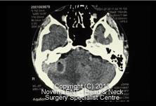 Brain abscess